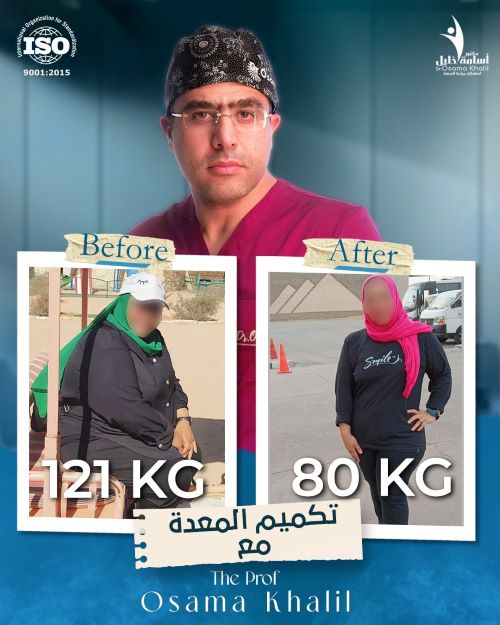 نصائح بعد عملية التكميم لتجنب ارتجاع المرئ